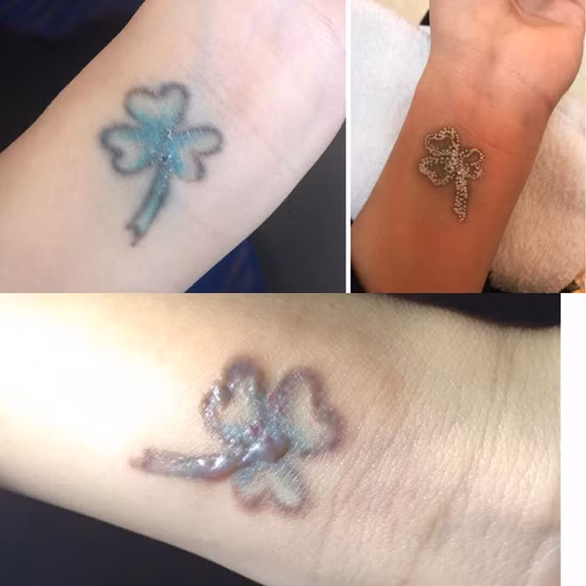 Những hình ảnh được dân mạng chia sẻ sau khi đi xóa xăm. Ảnh: FB.