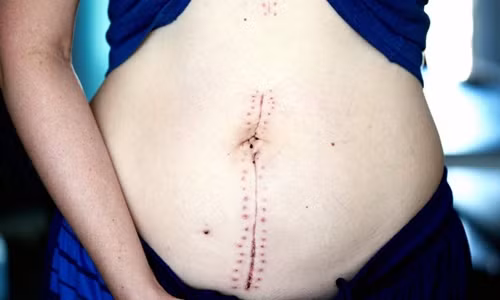 Sinh xong, san phu soc nang phat hien tu cung...bien mat