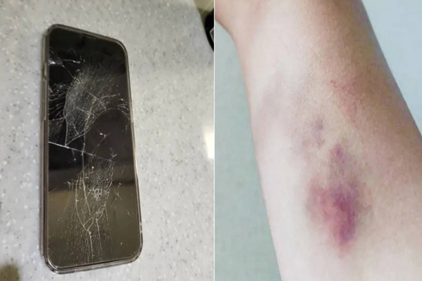 Ban gai duoc nhieu nguoi theo duoi, bac si lam dieu kinh hai