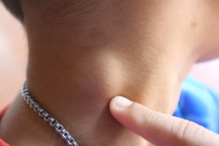 U, cục trên cổ. Bằng cách soi gương hoặc dùng tay khám quanh cổ, bạn sẽ phát hiện những u cục “không mời”. Theo chuyên gia sức khỏe, ung thư là sự tăng sinh bất thường của các tế bào gây bệnh. Theo thời gian, chúng sẽ tăng mạnh về kích thước dẫn đến hiện tượng nổi khối trên bề mặt cơ thể.