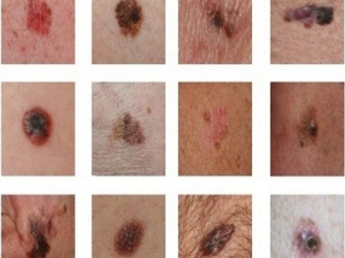 Ung thư da là ung thư hắc tố nên rất liên quan đến nốt ruồi. Đừng bỏ qua nếu nốt ruồi vùng cổ của bạn đổi màu, mở rộng kích thước đường viền hay những dấu hiệu bất thường trên bề mặt chúng.