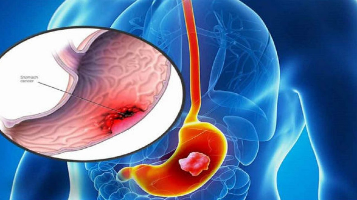 Hầu hết các trường hợp viêm loét dạ dày bắt nguồn từ vi khuẩn Helicobacter pylori (H.pylori). Để không phải khổ sở vì căn bệnh, ngoài việc dùng thuốc giảm axit và thuốc kháng sinh, chuyên gia sức khỏe khuyên người bệnh nên tận dụng triệt để lợi ích từ các nhóm thực phẩm ăn vào hàng ngày.