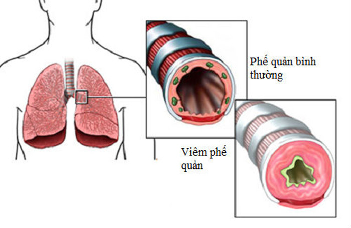 Trẻ mắc viêm phế quản thường có xu hướng nuốt đờm nhầy hơn là tìm cách khạc ra. Bệnh dễ nhầm lẫn với triệu chứng hen suyễn. Vì vậy, bố mẹ nên đưa con đi khám để được kê thuốc đúng bệnh tránh trường hợp tiến triển thành viêm phế quản mãn tính.