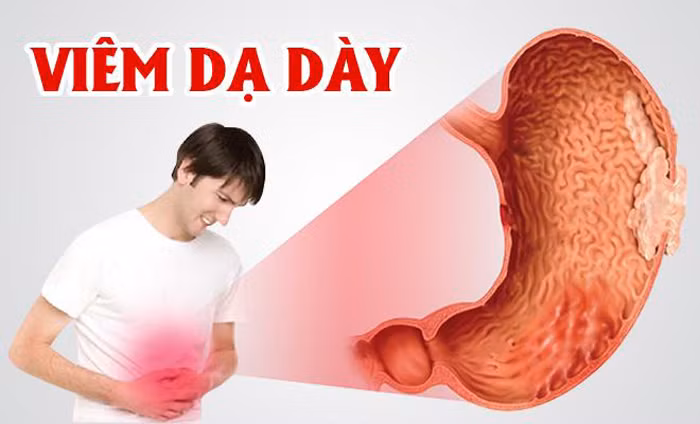 Các đối tượng âm hư hỏa vượng, viêm phổi, mắc chứng lao phổi, viêm loét dạ dày, viêm thận, đái tháo đường, trĩ, mọc nhiều mụn nhọt không thích hợp dùng gừng trong thời gian dài.