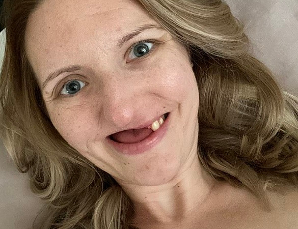 Ngoài loại bỏ khối u xương hàm, Nicole còn thực hiện xạ trị trong vòng 30 ngày. Thời gian này thực sự là thử thách với cô gái trẻ. Bất chấp sự nỗ lực của cô gái trẻ, cơn đau vẫn tiếp diễn và bác sĩ nhận thấy sự thay đổi vị trí răng của cô.