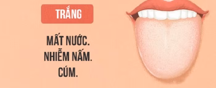 Lưỡi có lớp phủ kín màu trắng. Tùy vào tình trạng của lớp phủ màu trắng mà bạn có thể đang đối diện với nguy cơ sức khỏe khác nhau. Lưỡi bị phủ kín màu trắng có dịch nhờn chỉ ra dấu hiệu của bệnh tim mạch vành. Trường hợp màu lưỡi bất thường kèm suy nhược cơ thể là dấu hiệu thiếu máu. Nếu lớp phủ trắng bình thường lại là dấu hiệu của mất nước, nhiễm nấm hoặc cúm.