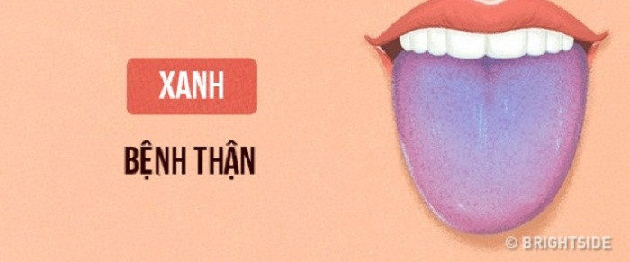 Lưỡi xanh hoa oải hương. Khác với màu tím sẫm ở trên, người có lưỡi chuyển màu này cho thấy thận không thể đào thải chất độc ra khỏi máu. Đôi khi nguyên nhân lại bắt nguồn từ việc không bổ sung đủ lượng nước cho cơ thể.