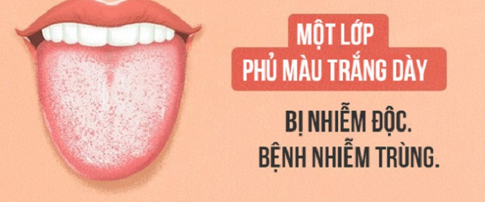 Lưỡi phủ lớp niêm mạc trắng dày. Lớp phủ niêm mạc này thường bắt nguồn từ các vấn đề dạ dày như nhiễm độc hoặc đang ăn kiêng quá mức. Bạn có thể xử lý chúng bằng cách sử dụng bàn chải đánh răng để gạt đi, điều chỉnh chế độ ăn hàng ngày.