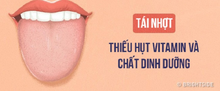 Lưỡi phủ lớp niêm mạc màu xám. Trong khi đó, lưỡi phủ một lớp niêm mạc mỏng hoặc không che phủ hết hoàn toàn bề mặt lưỡi thì lại là dấu hiệu thiếu hụt vitamin và dưỡng chất, đồng thời sức đề kháng cơ thể đang suy giảm nhanh chóng.