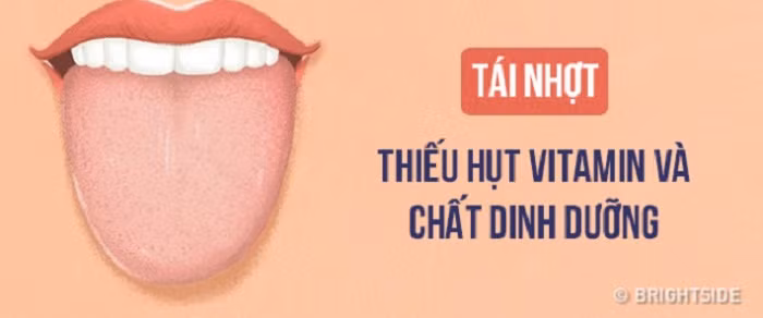 Lưỡi phủ lớp niêm mạc màu xám. Trong khi đó, lưỡi phủ một lớp niêm mạc mỏng hoặc không che phủ hết hoàn toàn bề mặt lưỡi thì lại là dấu hiệu thiếu hụt vitamin và dưỡng chất, đồng thời sức đề kháng cơ thể đang suy giảm nhanh chóng.