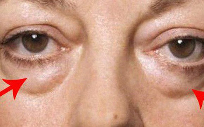 Xuất hiện bọng mắt. Một dấu hiệu chỉ ra thận đang bị hư hỏng là bạn có thể thấy bọng mắt xuất hiện. Các bọng quanh mắt của bạn bắt nguồn do thận bị rò rỉ lượng lớn protein vào nước tiểu.