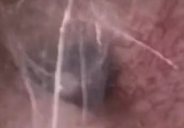 Kinh di nhen xam chiem giang to trong tai nguoi