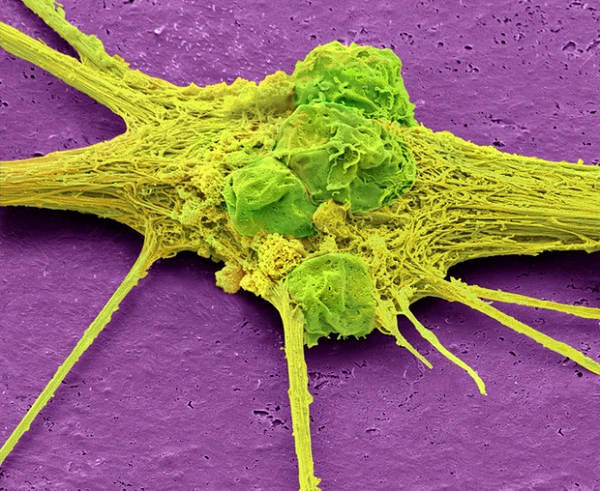 Một tế bào thần kinh có nguồn gốc từ tế bào gốc.