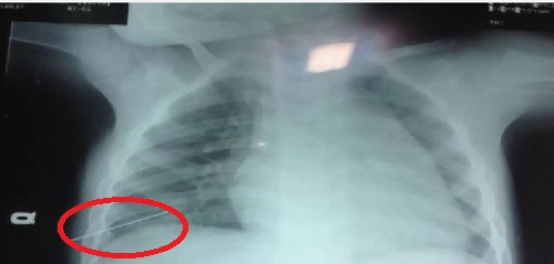 Cuu song be trai 3 tuoi bi kim dam xuyen long nguc