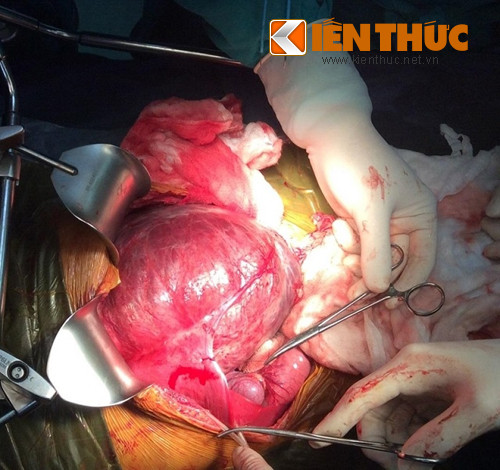 Cat thanh cong khoi u mau o gan be 9 tuoi