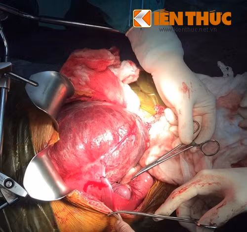 Cat thanh cong khoi u mau o gan be 9 tuoi