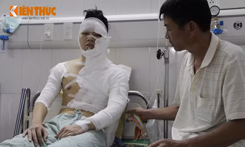 Mot sinh vien Ha Noi bị tạt axit lúc nủa dem