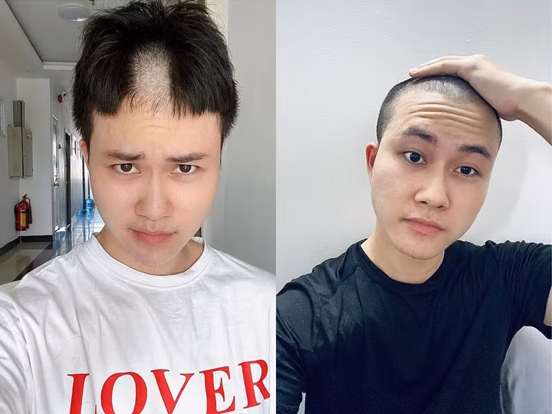 Thời tiết khá nắng nóng mà tiệm cắt tóc lại không mở cửa nên ca sĩ Lê Thiện Hiếu đã tự tay dùng tông đơ húi cua luôn cho nhanh và mát mẻ.