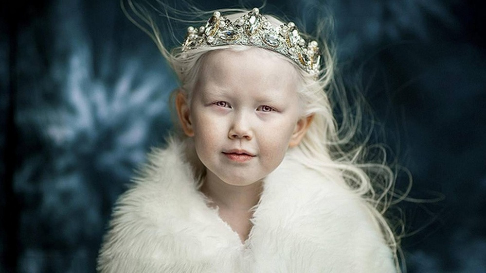 Bạch tạng là thuật ngữ để nói về những người mắc chứng rối loạn quá trình sinh sắc tố Melanin bẩm sinh. Điều này khiến cho da, tóc, mắt và lông của người bệnh có màu nhạt hơn bình thường và thường là màu trắng tinh.