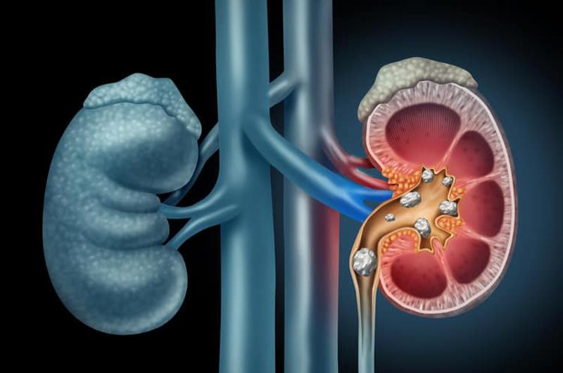 Khi ăn quá nhiều mận, mức oxalate có thể tập trung, cản trở hấp thu canxi trong cơ thể và kết quả là dẫn đến kết tủa canxi trong thận, dẫn đến hình thành sỏi nhỏ hoặc thậm chí lớn trong thận và bàng quang.