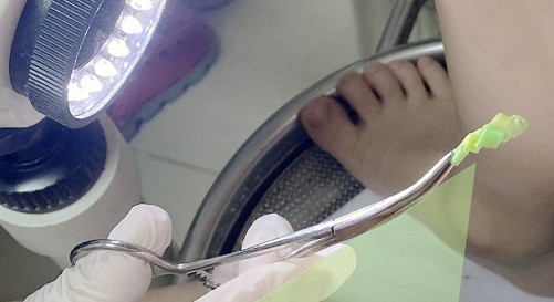 Be gai 4 tuoi bi viem vung kin, giat minh phat hien thu pham