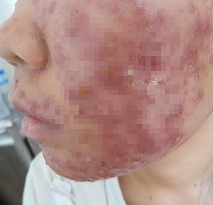 Đồng quan điểm với Hoàng Mỹ Anh là nickname Lan Hương chia sẻ: "Em từng là nạn nhân của các loại mỹ phẩm trôi nổi rồi các mẹ ạ. Trước có mua thỏi son handmade của một shop trên mạng. Mặc dù là son dưỡng nẻ mà đánh xong còn thấy môi sưng sưng, sau đi khám mới biết bị viêm da. Sợ lắm".