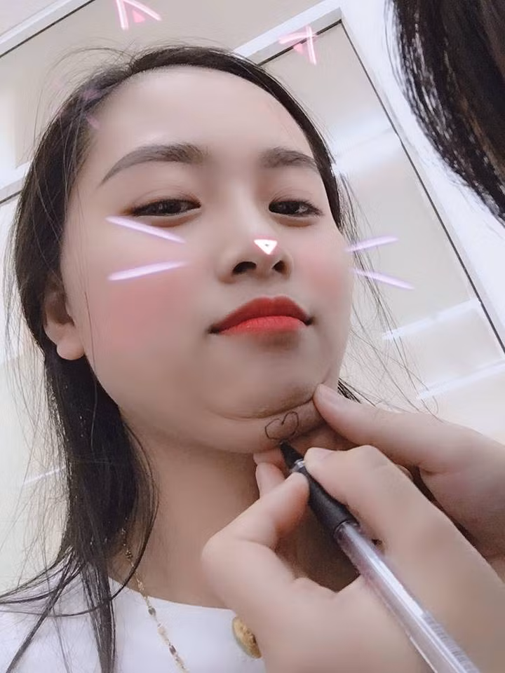 Thực ra, cằm nọng từng là nỗi khổ tâm của rất nhiều người. Luôn có kiểu người mà ăn bao nhiêu cũng chỉ mập mỗi mặt. Lắm khi người thì rõ ràng là thon thả, mảnh mai vậy mà cằm lúc nào cũng đầy đủ nọng lớn, nọng bé.