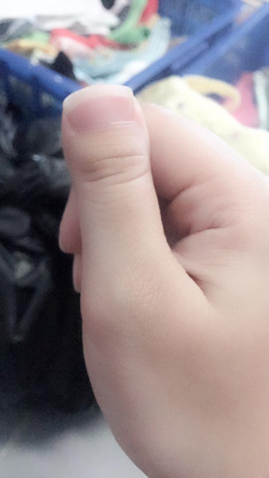 Chiều cao con người có thể lùn vì vậy chẳng có lý do gì mà ngón tay ngón tay không có thể bị "nấm lùn".