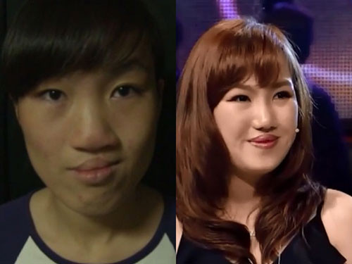 Nguyễn Thị Ngọc Lê (22 tuổi, hiện sinh sống và làm việc tại Thái Nguyên) được biết đến sau chương trình truyền hình thực tế thay đổi cuộc sống. Trước khi phẫu thuật để có khuôn mặt như ngày nay, Ngọc Lê bị hở hàm ếch và khuôn mặt bị biến dạng. Sau nhiều lần phẫu thuật gọt hàm, chỉnh sửa môi, cắt mí và nâng mũi, Ngọc Lê mới có được khuôn mặt hiện tại. Cô phải mất rất nhiều thời gian để thực hiện những cuộc phẫu thuật thẩm mỹ này.