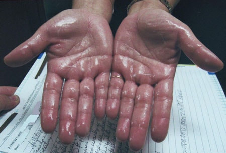 Còn nickname Quỳnh Nga bình luận: ''Ngày trước, ngoài mồ hôi tay ra mình còn bị ở lưng nữa và mỗi khi lên bảng trả bài hay làm bài mình chảy mồ hôi ướt nhẹp đến nỗi nhỏ cùng bàn thấy thương còn phải quạt cho''.