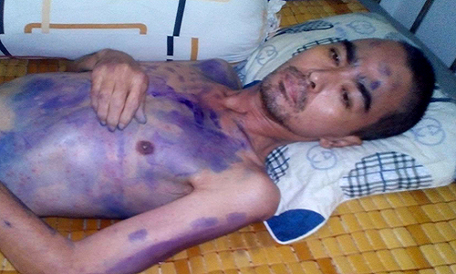 Nguyễn Hoàng bị sốt liên miên do mắc thủy đậu, lây từ con trai.