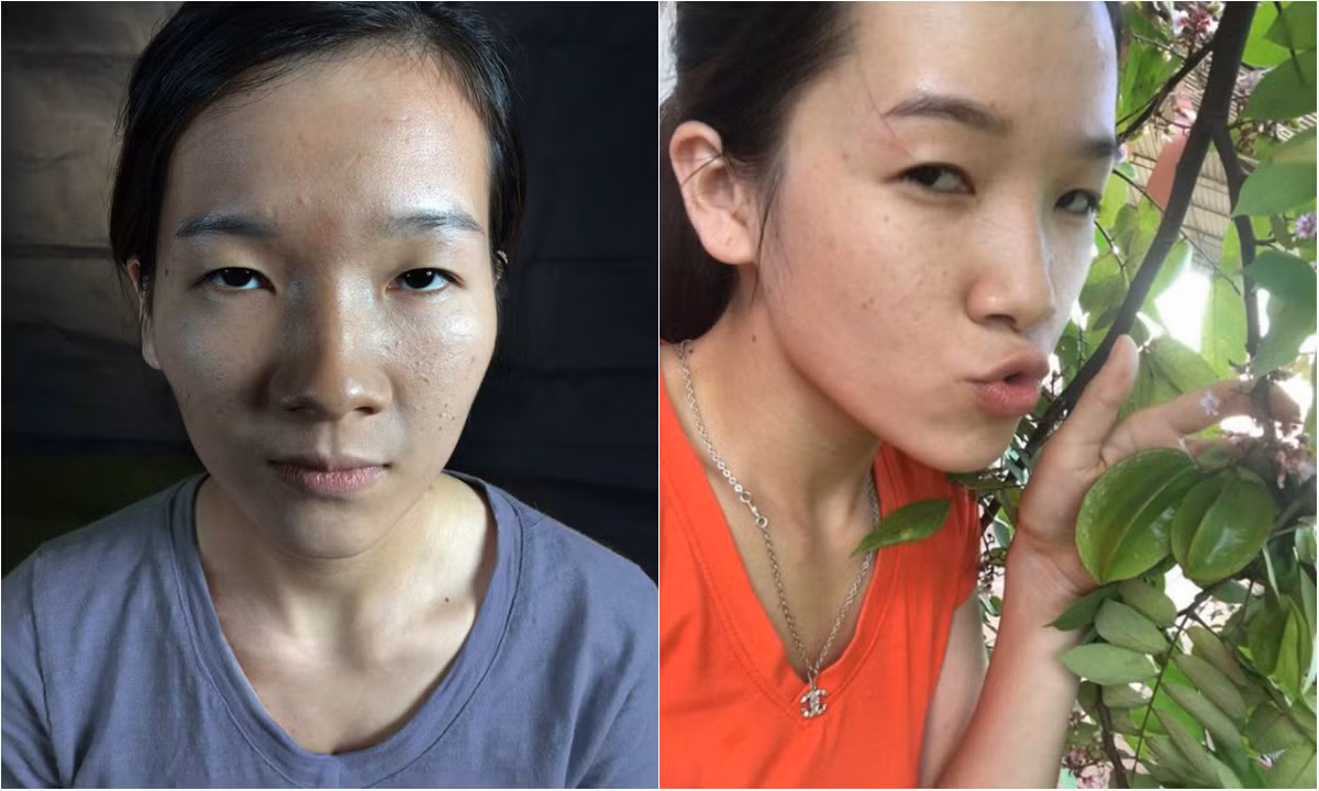 Cách đây chưa lâu, cộng đồng mạng đã truyền tai nhau những dòng tâm sự buồn của nữ sinh trường Y - Nghệ An về khuôn mặt kém xinh với "đôi mắt lươn" gây ảnh hưởng tới rất nhiều tới công việc cũng như tình cảm. Ảnh trong bài: FBNV.