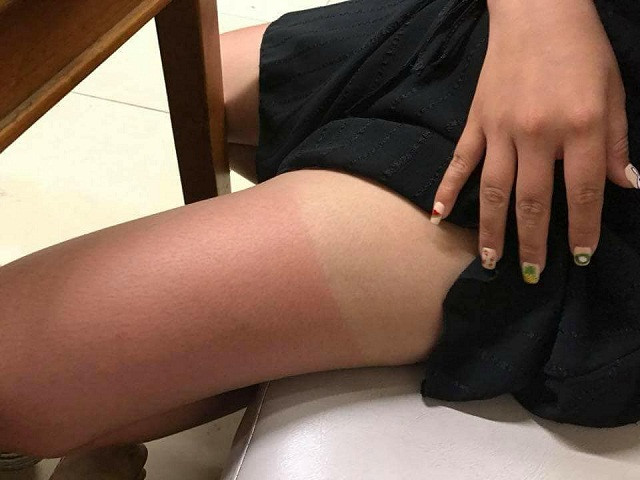 Da hai màu là làn da điển hình của mùa hè khiến nhiều người, đặc biệt là các bạn gái phải buồn lòng.