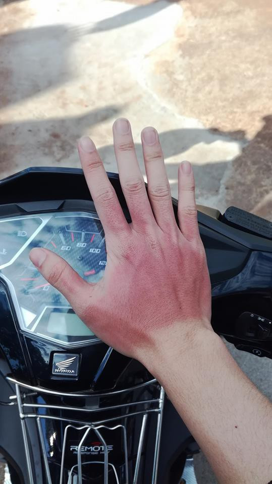 Khi nhiệt độ bên ngoài cứ 38, 39 độ thì ai muốn ra đường. Cũng bởi thế mà nhiều cô gái tự biến mình thành Ninja với áo chống nắng kín mặt, kín tay. Nhưng dù có cố che chắn ra sao một khi đã sở hữu làn da bắt nắng thì việc cháy nắng mùa hè là điều khó tránh khỏi.