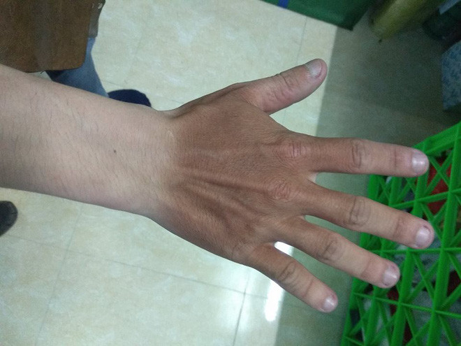 Trong một page đông thành viên trên facebook đã diễn ra một cuộc "khoe" mức độ cháy nắng phiên bản đặc biệt của mình. Đa phần, dân mạng đều chia sẻ những bức ảnh làn da chia 2 màu rõ rệt "nửa đen - nửa trắng" của mình.