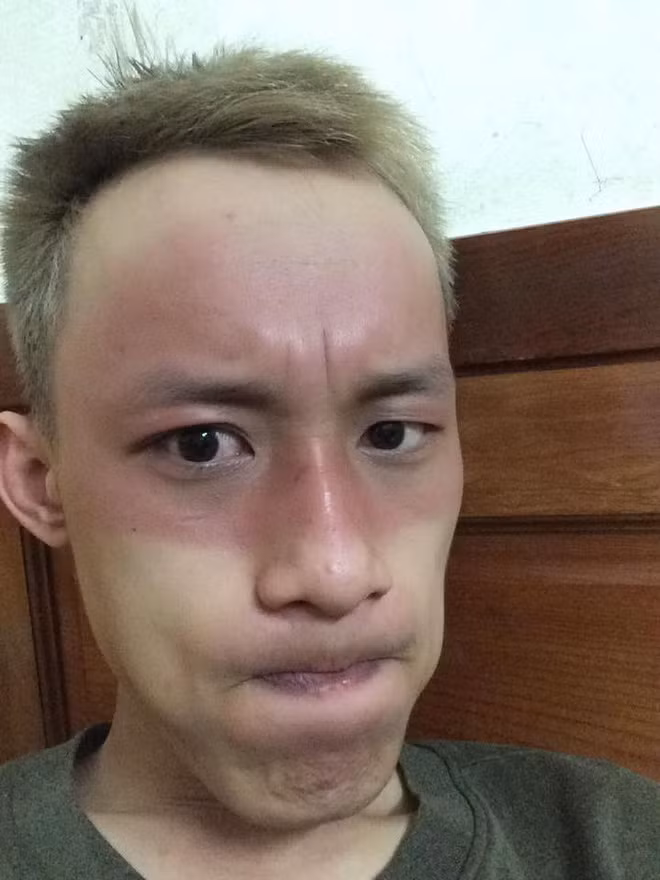 Một bộ phận không nhỏ trong số người làm nghề thường xuyên phải chạy bên ngoài đường như shiper, xe ôm công nghệ thì tình trạng da chia hai màu diễn ra là điều khó tránh khỏi.