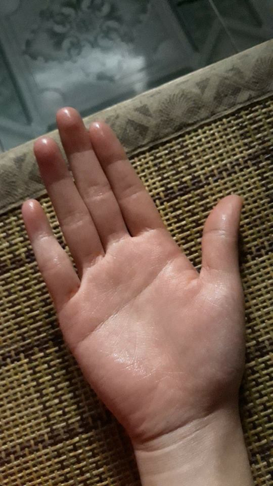 Với nỗi khổ đổ mồ hôi tay, các bạn trẻ cũng vì vậy mà ít hoạt động cường độ mạnh như tập luyện, chơi thể thao nếu không muốn mình ướt nhẹp.