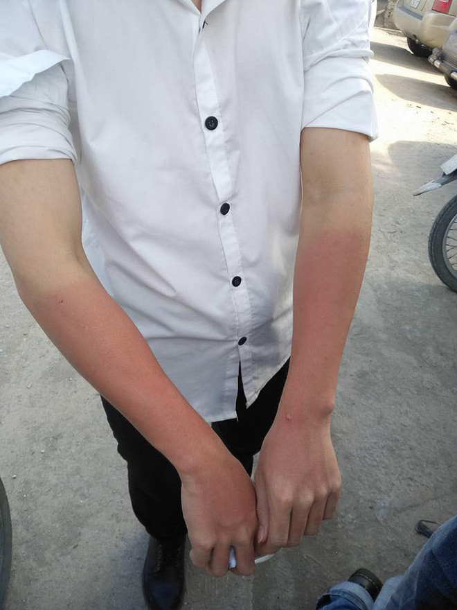 Giữ da 3 năm, cháy nắng 1 giờ là điều mà dân mạng thường tự an ủi nhau mỗi khi mùa hè tới.