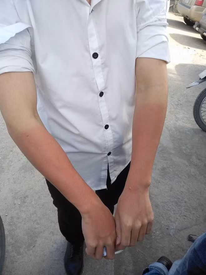 Giữ da 3 năm, cháy nắng 1 giờ là điều mà dân mạng thường tự an ủi nhau mỗi khi mùa hè tới.