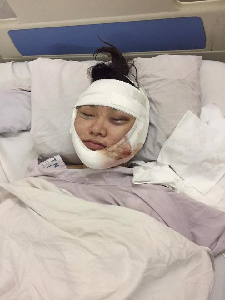 Khuôn mặt xưng húp của Kiều Anh sau khi phẫu thuật được chụp lại và chia sẻ lên mạng xã hội.