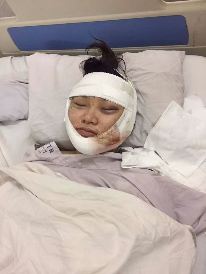 Khuôn mặt xưng húp của Kiều Anh sau khi phẫu thuật được chụp lại và chia sẻ lên mạng xã hội.