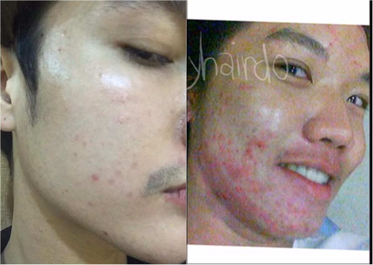 Việc thay đổi tiết tố trong giai đoạn dậy rất phổ biến, vì vậy, nhiều chàng trai đã gặp vấn đề khi bị bạn gái chê bai, từ bỏ không thương tiếc, chỉ vì "mặt quá nhiều mụn"... điển hình như trường hợp của chàng trai Thái Lan mới đây. Ảnh trong bài: Facebook nhân vật.