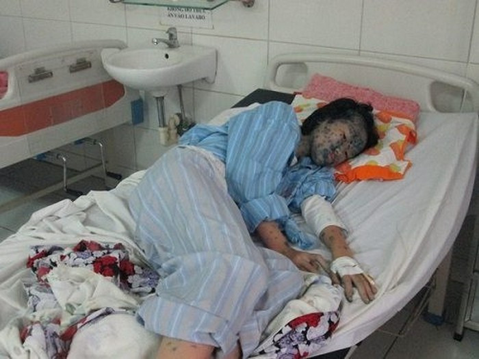 Hình ảnh người mẹ đang cho con bú bị dính virut thủy đậu.