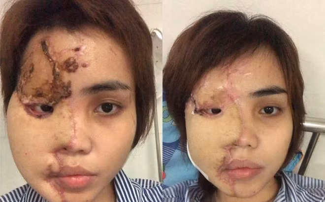 Co gai bi thieu uy CA tat axit noi gi ve tin “bat ca 2 tay”?