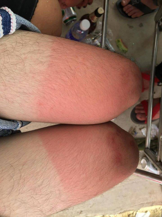 Có thể nói, mùa hè dù bạn có che chắn kỹ lưỡng cỡ nào thì vẫn có những chỗ không thể che tới và đó chính là mục tiêu "tấn công" của nắng.