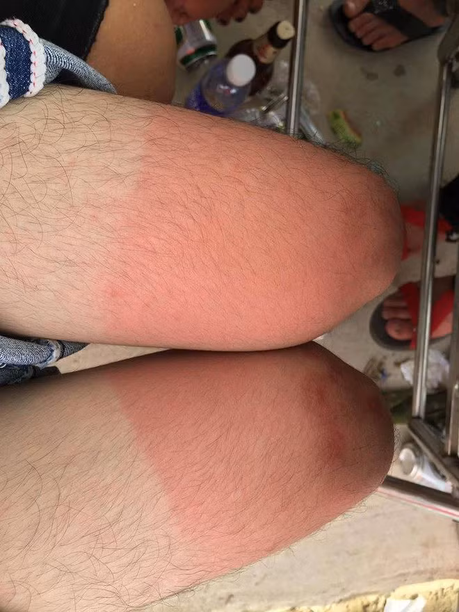 Có thể nói, mùa hè dù bạn có che chắn kỹ lưỡng cỡ nào thì vẫn có những chỗ không thể che tới và đó chính là mục tiêu "tấn công" của nắng.