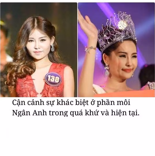 Đôi môi "lạ" của Ngân Anh bị so sánh giữa hiện tại và quá khứ. Ảnh trong bài: Sưu tầm Facebook.