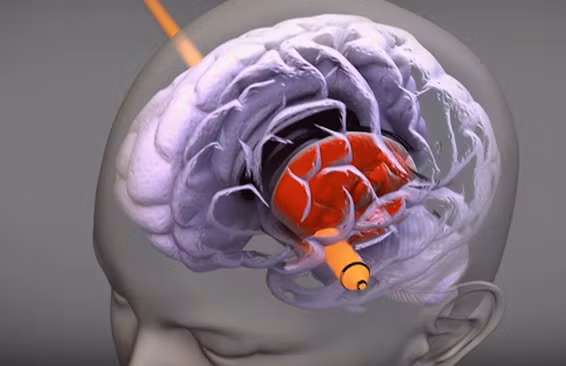 Cơ quan công tố còn lưu ý một tình tiết: Viên đạn đầu tiên xuyên qua vùng não trung tâm điều khiển các chức năng vận động. Vì thế, ngay cả khi Sandra vẫn sống sau phát đạn thứ nhất, cô cũng không thể thực hiện thao tác siết cò lần thứ hai.