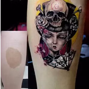 Không chỉ có những vết sẹo lồi, hình xăm còn che được những vết bớt, chàm hay nám một cách “thần kỳ”.