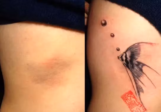 Ngoài những hình xăm truyền thống thì những mẫu xăm theo phong cách 3D cũng là một cứu cánh để che đi vết sẹo.